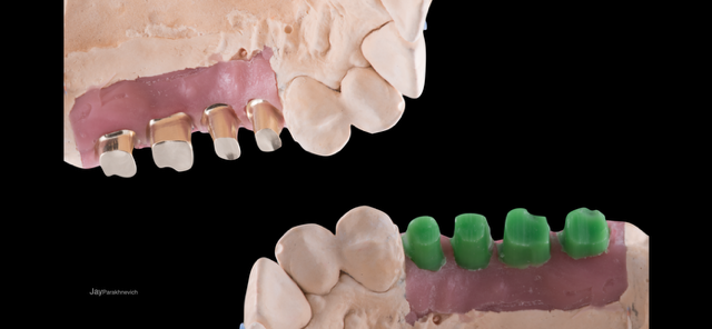 Diagnostic Wax-Ups