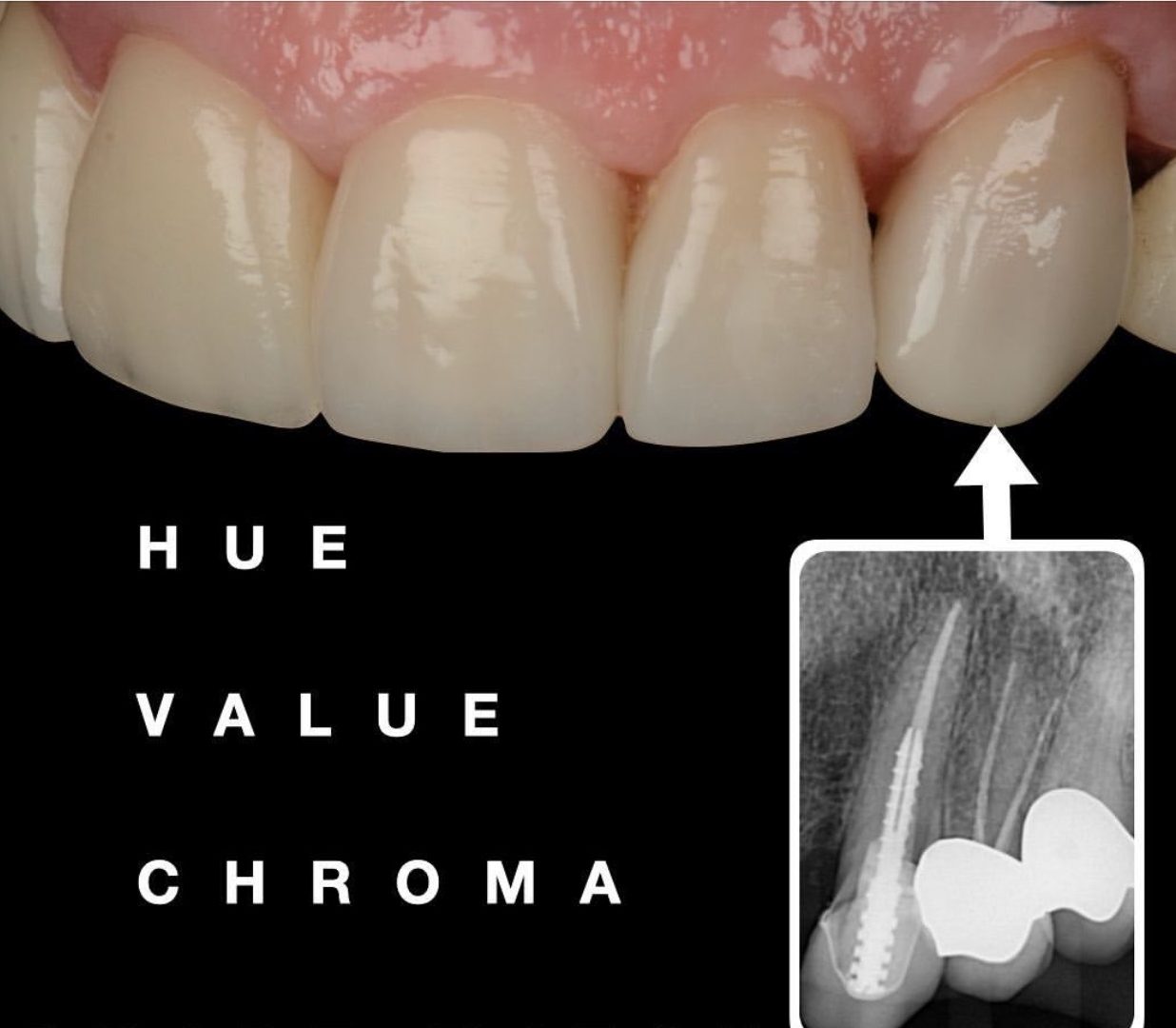 Emax Crowns & Veneers