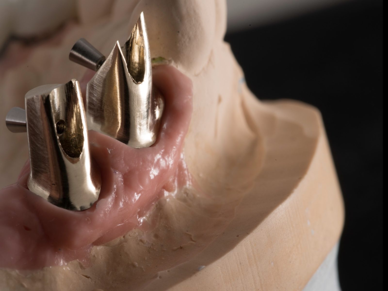 Custom Implant Restorations